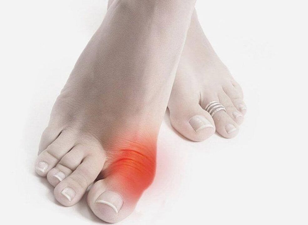 symptômes de la goutte au pied